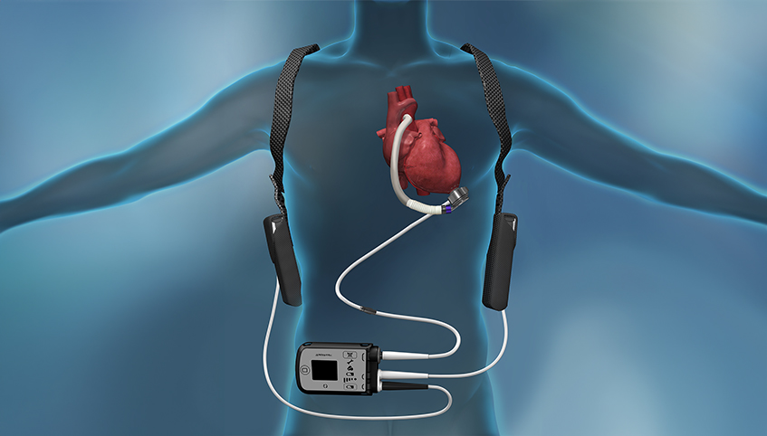 Heart Pump Device Market