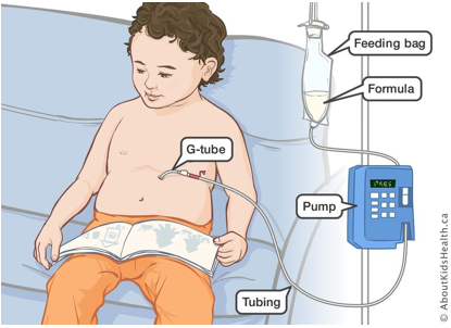 Enteral Feeding Devices Market